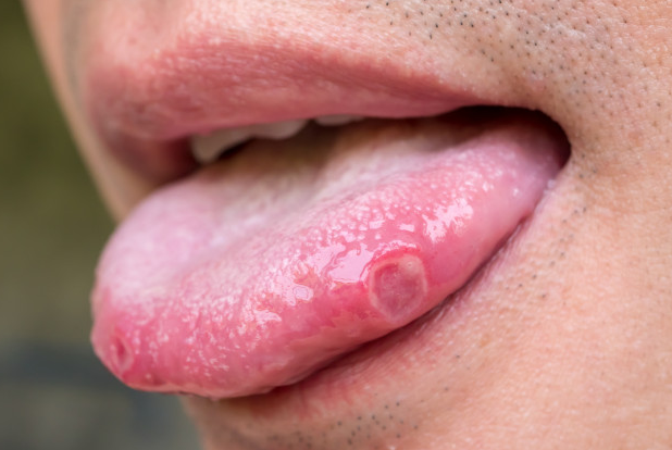 तोंड येणे-TONGUE ULCER-MOUTH ULCER-TREATMENT