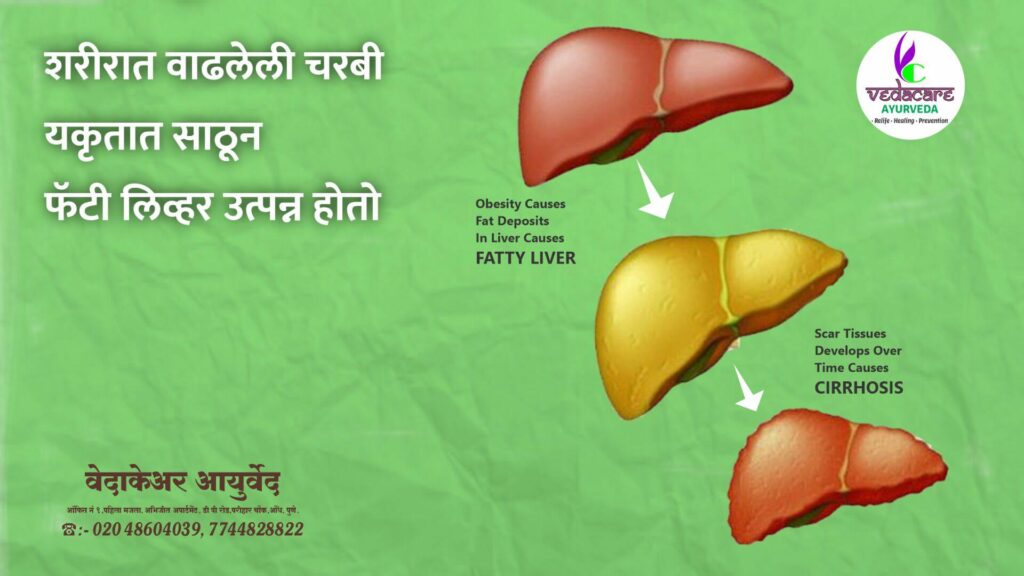 ayurvedic-medicine-for-fatty-liver