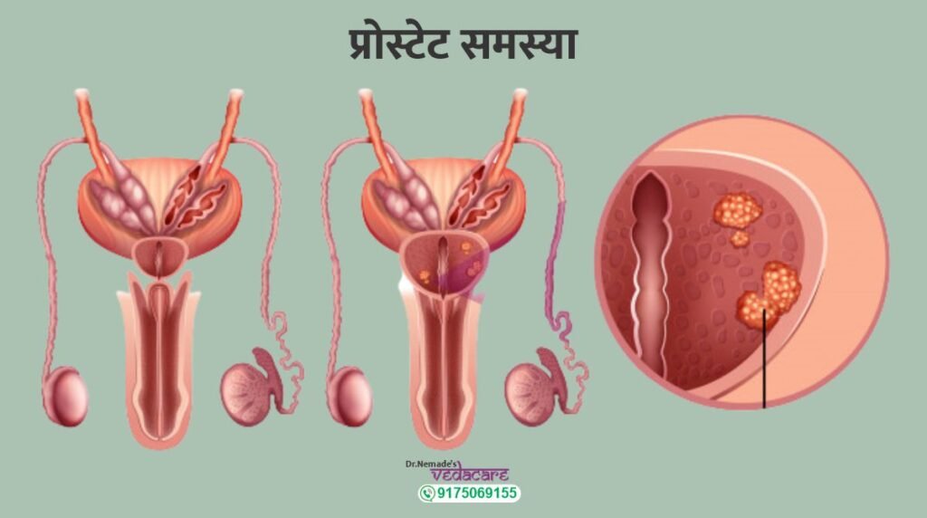 prostate ayurvedic treatment