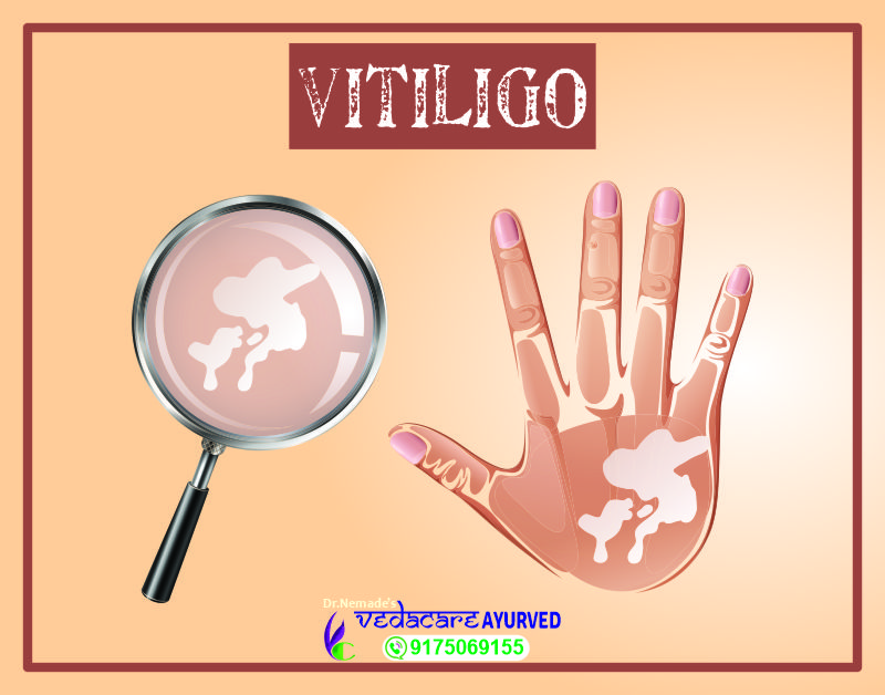 पांढरे कोड VITILIGO