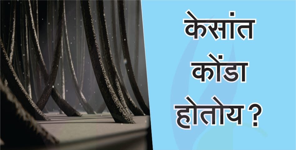केसातील कोंडा (Dandruff) – आयुर्वेदिक कारणे आणि उपाय – डॉ. हर्षल नेमाडे, Vedacare Ayurveda, औंध, पुणे