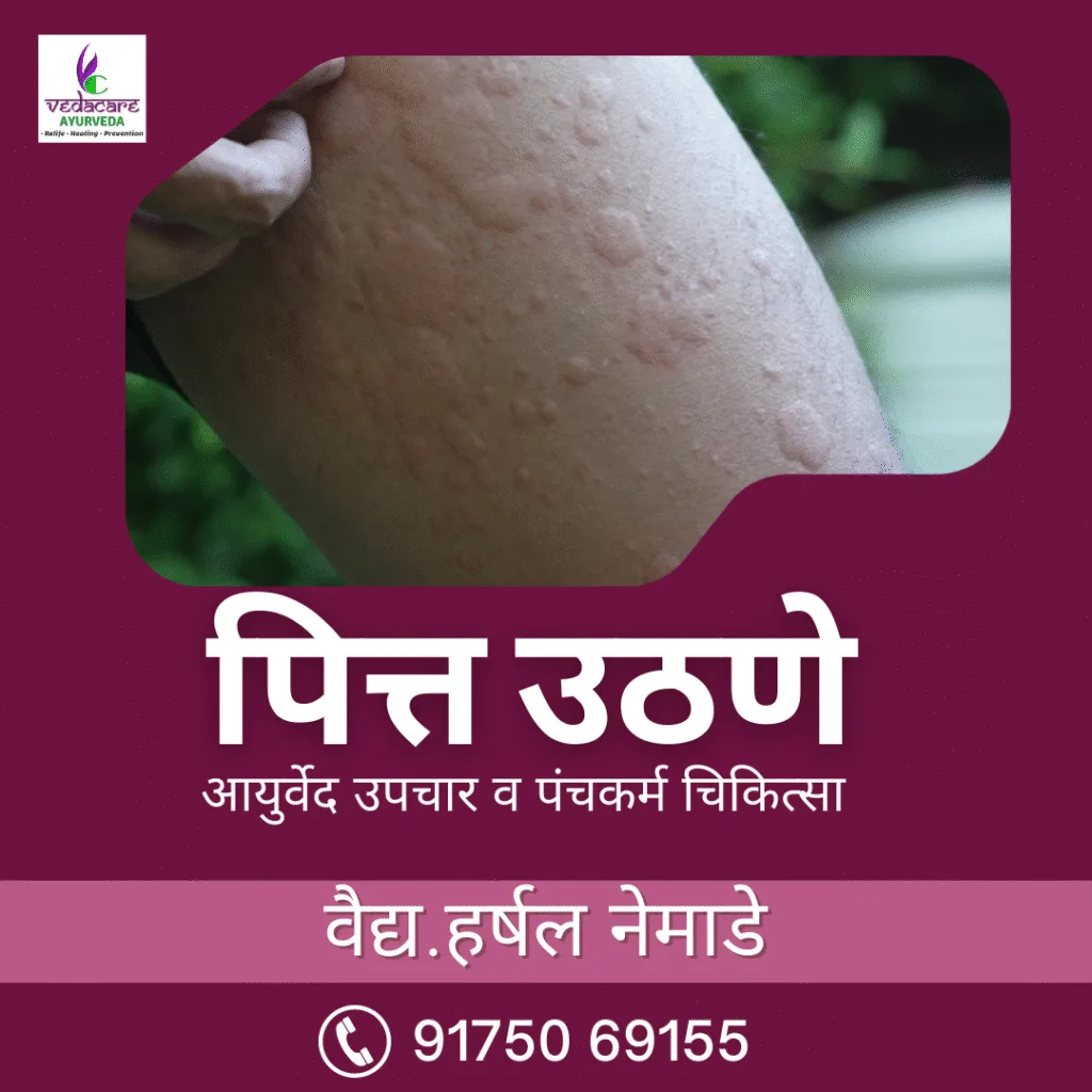 urticaria hives shitpitta pitti khaj yene