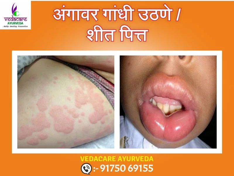 पित्त उठणे-शितपित्त आणि त्वचेला खाज येणे – आयुर्वेदिक उपाय 3 urticaria