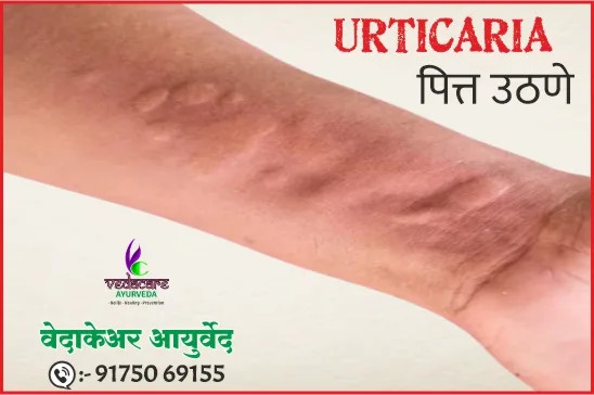 शीतपित्त (urticaria) वर आयुर्वेदिक उपचार