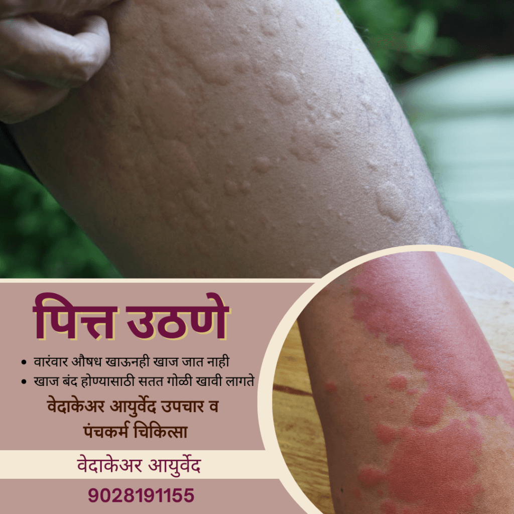 शीतपित्त Urticaria अंगावर पित्त उठणे आयुर्वेदिक उपचार पुणे